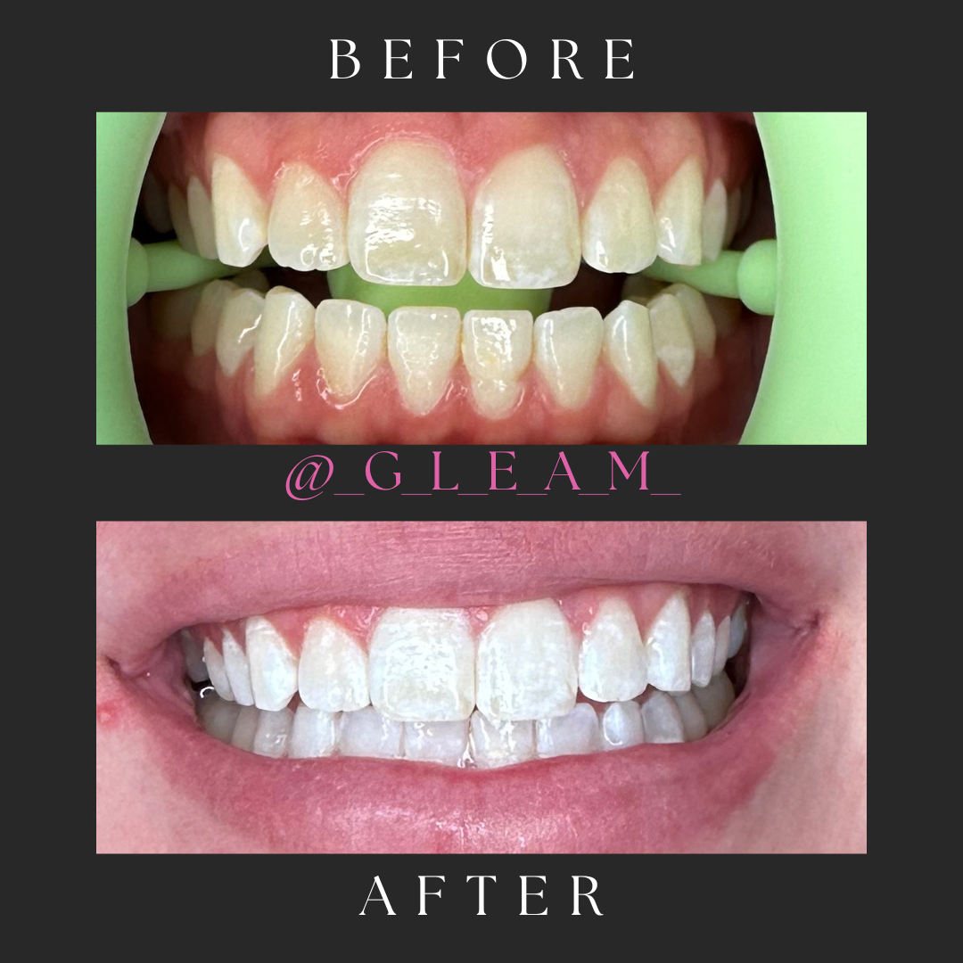 Teeth Whitening Treatment with GLEAM