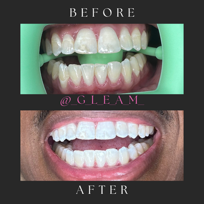 Teeth Whitening Treatment with GLEAM